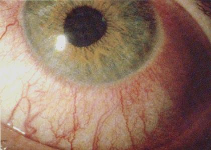 Симптомы болезней - Красные глаза
