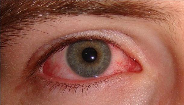 Симптомы болезней - Сухие глаза